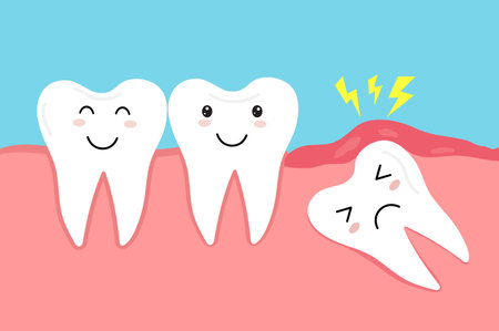 Impacted wisdom tooth. Crooked teeth. Toothache molar. inflamed swollen gum.のイラスト素材