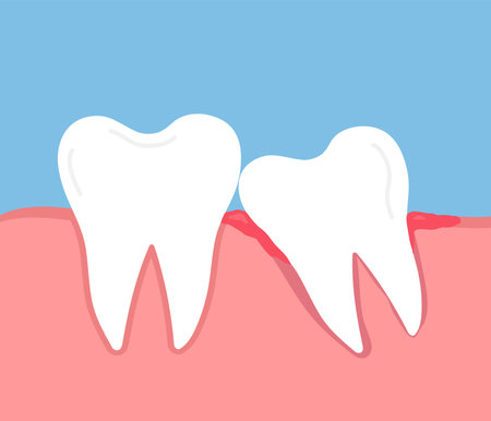 Impacted wisdom tooth. Crooked teeth. Toothache molar. inflamed and swollen gumのイラスト素材