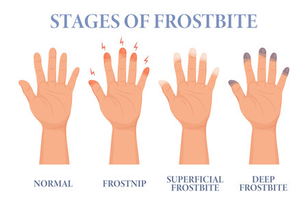 Frostbite stages. Frozen hands in different stages. Medical frostbite. Skin burn symptom. Health care medical concept. vectorのイラスト素材