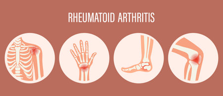 Rheumatoid arthritis icons. Knee joint, shoulder joint, wrist joint, foot joint. Types of arthritis. Medical concept. vectorのイラスト素材