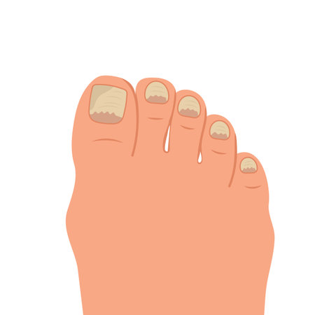 Swollen toe, onychocryptosis. Foot with nail disease or infection. Foot with onychomycosis or nail fungus. Healthcare and medicine. Vectorのイラスト素材