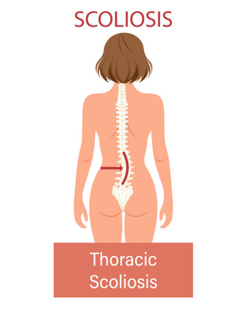 Scoliosis, a disease of the spine. Infographic banner with scoliosis of the human spine. Healthcare and medicine. Illustrationのイラスト素材