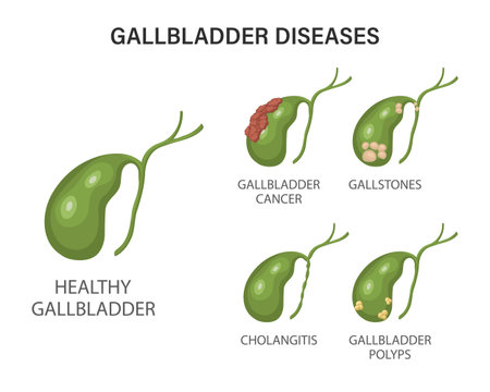 Gallbladder diseases infographics. Gallstone disease, cancer, acute cholecystitis, cholangitis or polyps of the digestive system. Problems with the biliary tract. Illustrationのイラスト素材