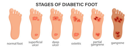 Stages of diabetic foot syndrome. Deep ulcer, open wound on the foot. Diabetic foot or diabetes, gangrene, necrosis, neuropathy, necrotizing fasciitis. Medical infographics bannerのイラスト素材