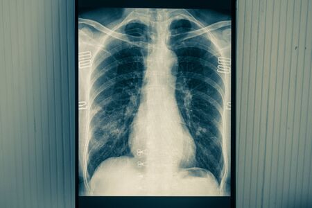 x-ray film from patient infected coronavirus COVID19の写真素材