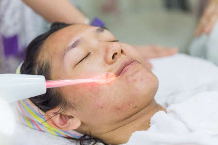 Beauty treatment of face skin with high frequency infrared spot or laser spot remover in SPA center.の写真素材