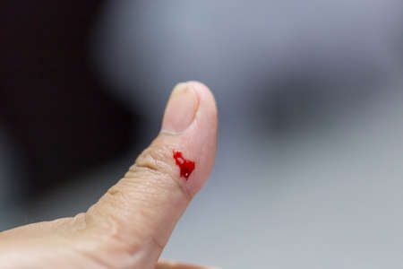 Closeup view of finger on left thumb human hand is cut hurt and bleeding with bright red blood.の写真素材