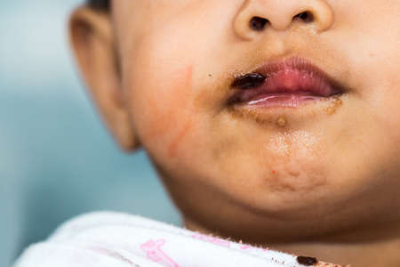 A child is eating sweets and tooth decay.の写真素材
