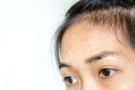 Acne inflammation on the face of young womenの写真素材