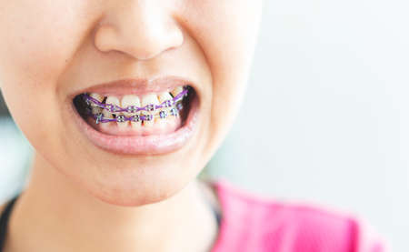 Women braces and is dirty, not beautiful.