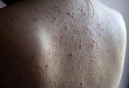 woman back with acne, red spots, skin diseaseの写真素材