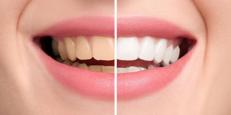 Woman displaying a close-up half-face smile illustrating the contrast between yellowish, discolored teeth and bright, white teeth after a successful dental whitening treatmentの素材