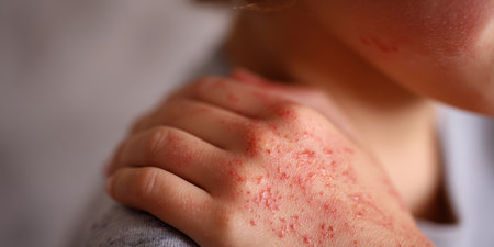 Child's hand suffering from severe eczema, displaying red, inflamed skin with an itchy rash and visible irritation, indicating a common dermatological condition in childhoodの素材