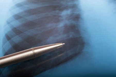 X-ray examination of human chest and gold penの写真素材