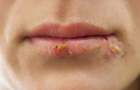 Close up of lips affected by herpesの写真素材