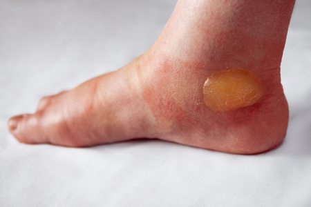 Huge painful blister on the burnt footの写真素材