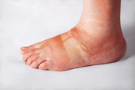 Sore woman foot with blistersの写真素材