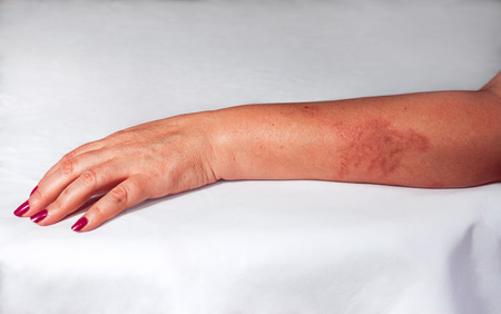 Redness from painful burn on woman handの写真素材