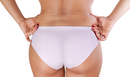 Woman fat body with cellulite and stretch marks on the back の写真素材