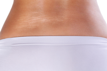 Woman body with strong stretch marksの写真素材