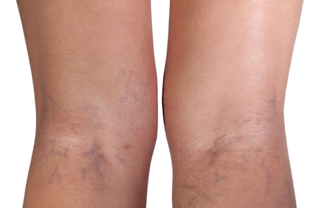 Varicose veins on woman legs, close up の写真素材