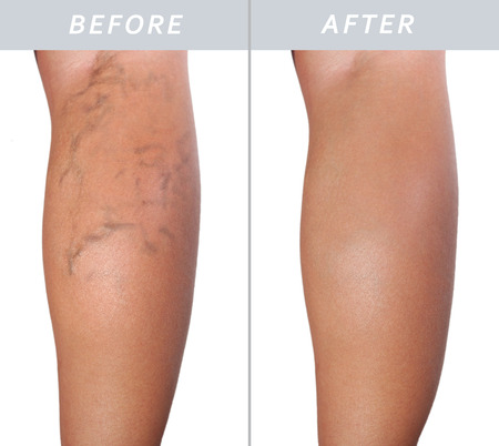 Adult woman leg with varicose veins before and after treatment isolate on whiteの写真素材
