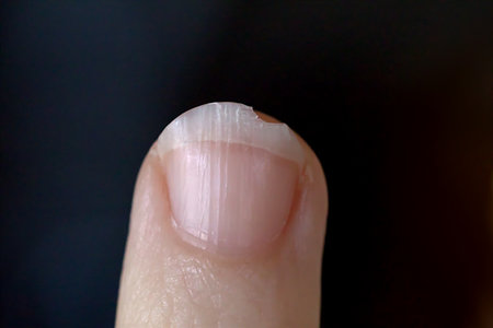 Broken Fingernail in need of a Manicureの写真素材