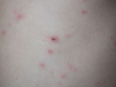 Treatment of ulcers from chickenpox, varicella with medical cream on the kid skinの写真素材