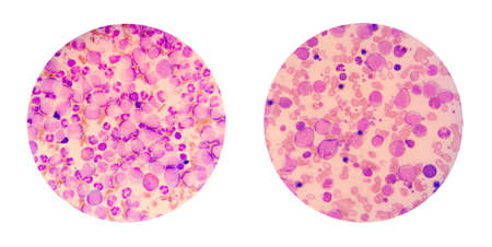 Microscopic views of a blood smear from leukemia patient show many abnormal white blood cells,...
