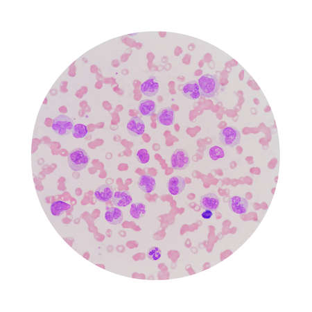 Microscopic view of a blood smear from leukemia patient showing many abnormal white blood cells, blood cancer cells or leukemia cells.の写真素材