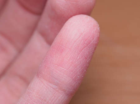 Close up look of Broken finger skin during winter or cold weatherの写真素材
