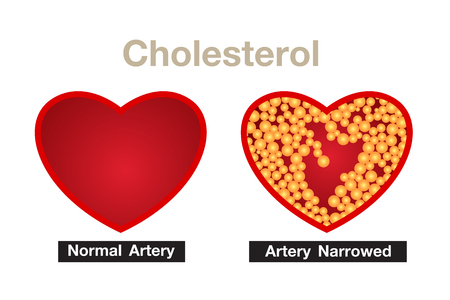 Cholesterol in artery, health risk , vector designのイラスト素材