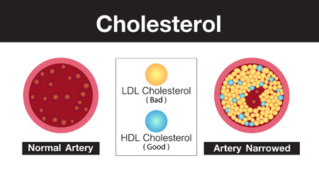 Cholesterol in artery, health risk , vector designのイラスト素材