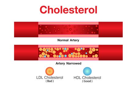 Cholesterol in artery, health risk , vector designのイラスト素材