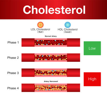 Cholesterol in artery, health risk , vector designのイラスト素材