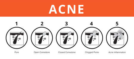 Acne, stages of development, healthy skin, vector designのイラスト素材