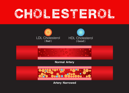 Cholesterol in artery, health risk , accumulation blood, Obesity, vector designのイラスト素材