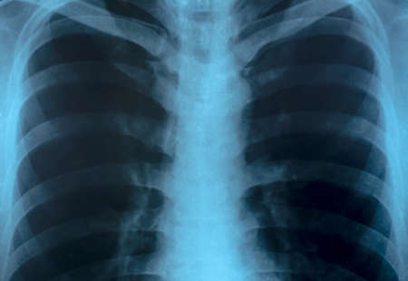X-Ray Image Close up Of Human Chest
