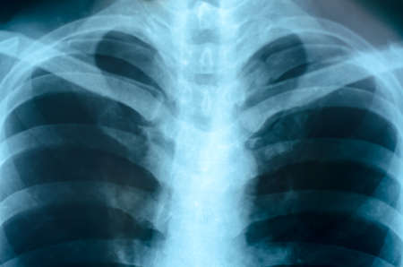 X-Ray Image Close up Of Human Chestの写真素材