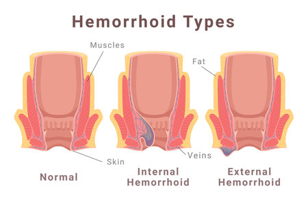 Hemorrhoid types scheme with normal internal and external poster isometric vector illustrationのイラスト素材