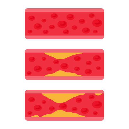 Vascular vectors. Fat arteries clog the blood flow in the body. It is most common in obese patients.のイラスト素材