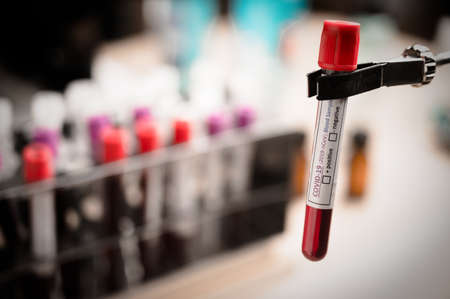 COVID-19 test and laboratory sample of blood testing for diagnosis new Corona virus infection....