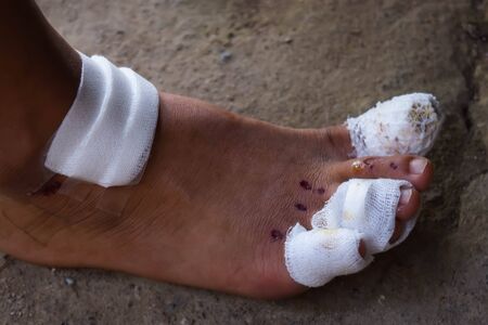foot ulcersの写真素材