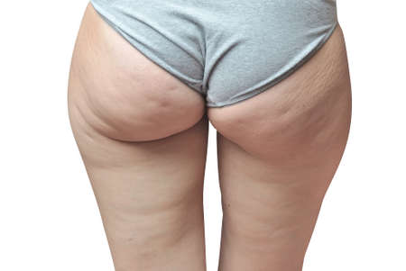 Cellulite at woman buttocks isolated on whiteの写真素材