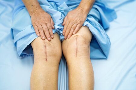 Asian senior or elderly old lady woman patient show her scars surgical total knee joint replacement...