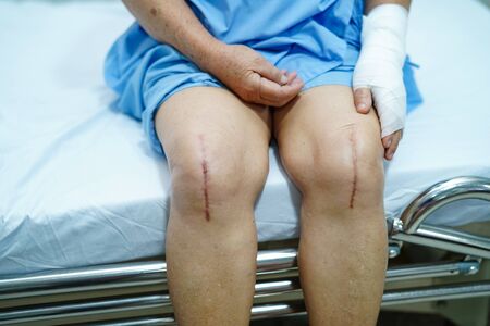 Asian senior or elderly old lady woman patient show her scars surgical total knee joint replacement Suture wound surgery arthroplasty on bed in nursing hospital ward : healthy strong medical concept.の写真素材