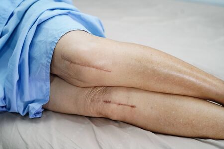 Asian senior or elderly old lady woman patient show her scars surgical total knee joint replacement...