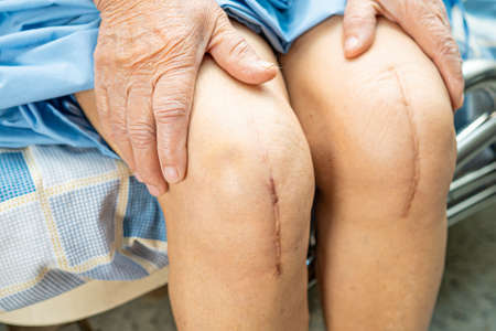 Asian senior or elderly old lady woman patient show her scars surgical total knee joint replacement Suture wound surgery arthroplasty on bed in nursing hospital ward, healthy strong medical concept.の写真素材