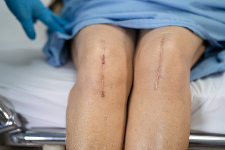 Asian senior or elderly old lady woman patient show her scars surgical total knee joint replacement...