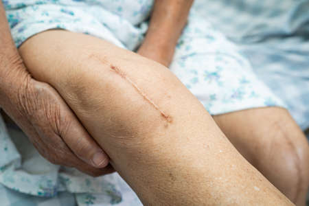 Asian senior or elderly old lady woman patient show her scars surgical total knee joint replacement Suture wound surgery arthroplasty on bed in nursing hospital ward, healthy strong medical concept.の写真素材